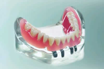 implantologia-dentale-full.jpg